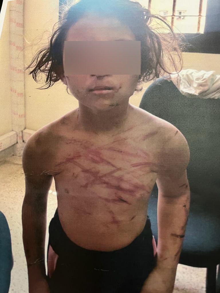 تجردت من مشاعر الأمومة.. سيدة عشرينية تعتدي بوحشية على ابنتها القاصر بمدينة سلا الجديدة (صورة) تجردت من مشاعر الأمومة.. سيدة عشرينية تعتدي بوحشية على ابنتها القاصر بمدينة سلا الجديدة (صورة)