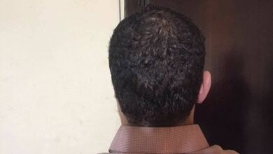 بتر أذن