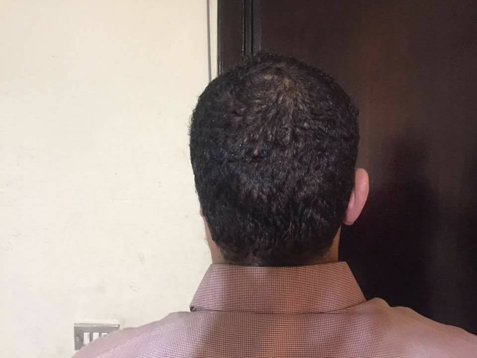 بتر أذن