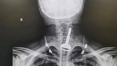 سعودي يبتلع مفتاح سيارته