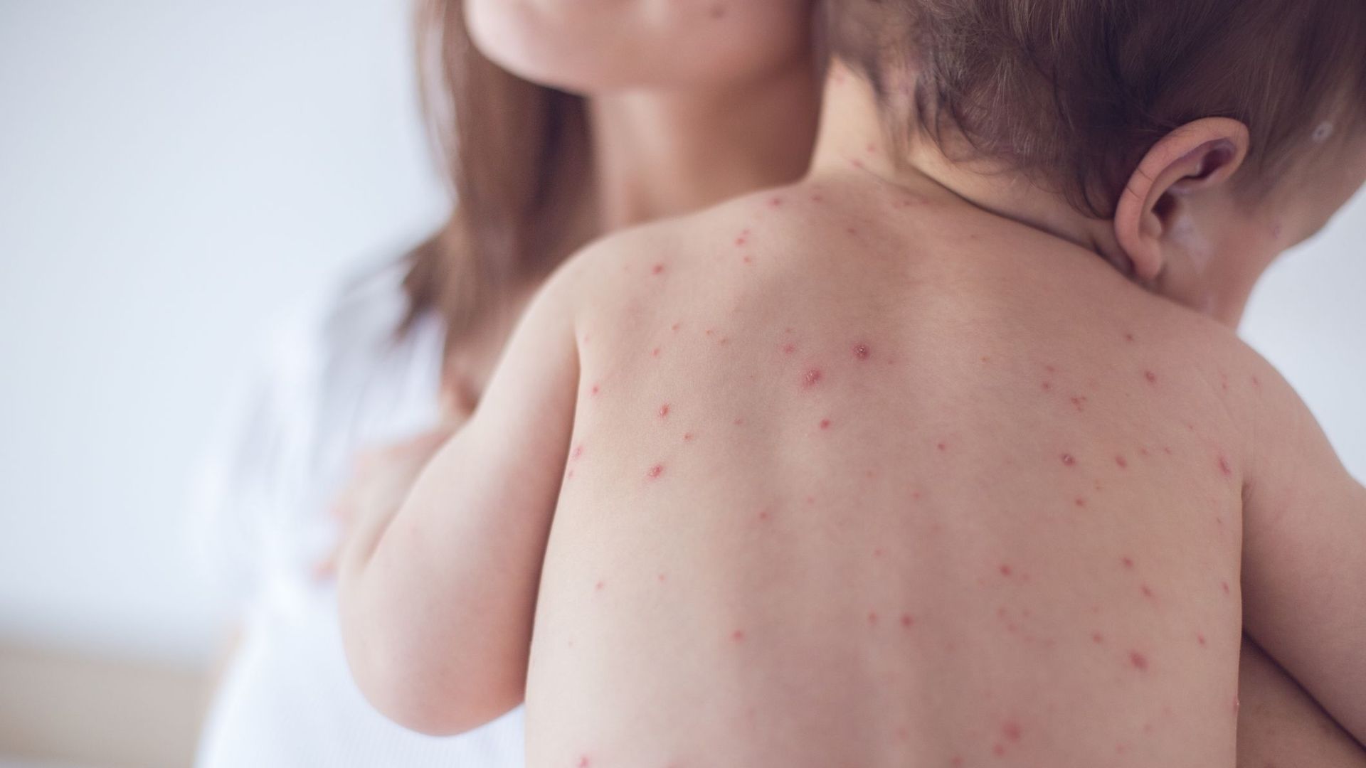 "بوحمرون"..استنفار بالمدارس لاتخاذ تدابير وقائية 1 rougeole